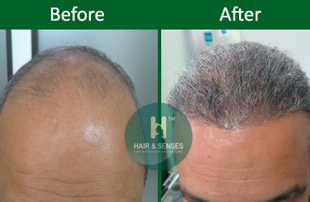 FUE Hair Transplant